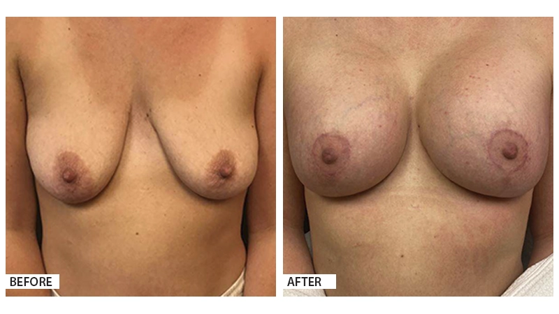 Breast Augmentation