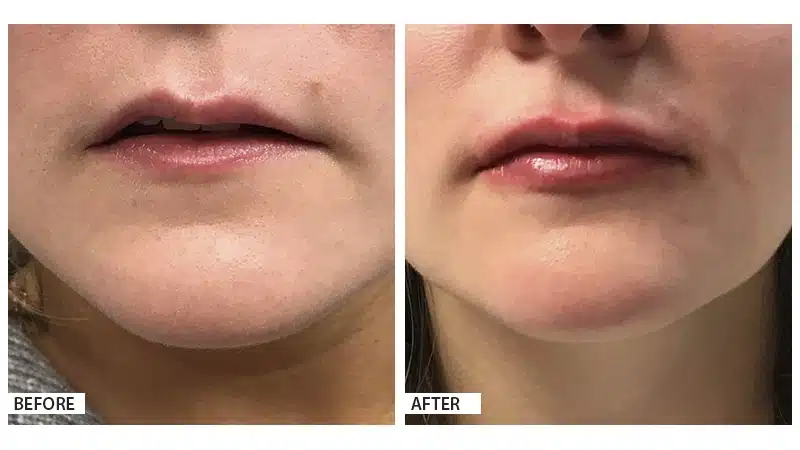 Lip Filler