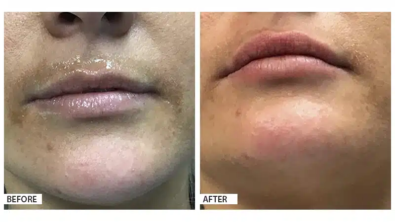 Lip Filler