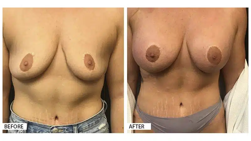 Breast Augmentation