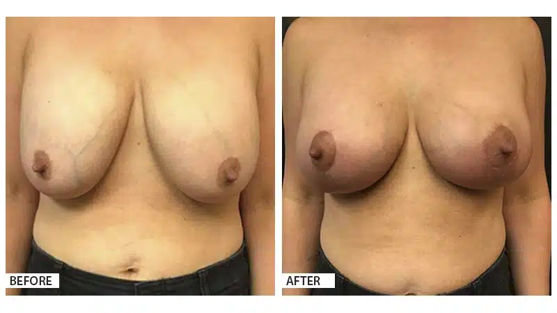 Breast Augmentation