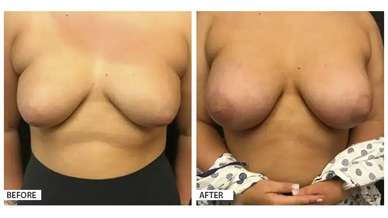 Breast Augmentation