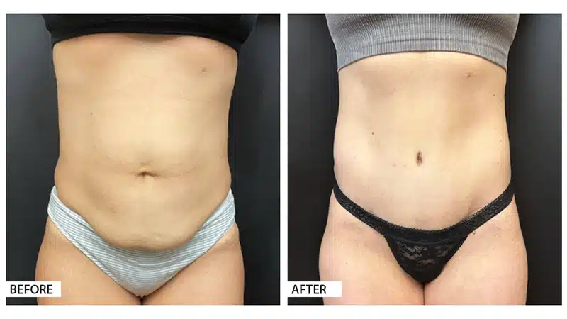 Tummy Tuck