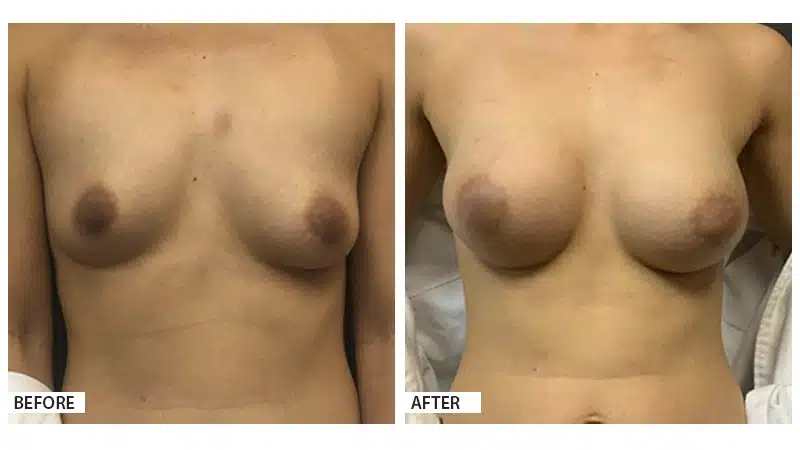 Breast Augmentation