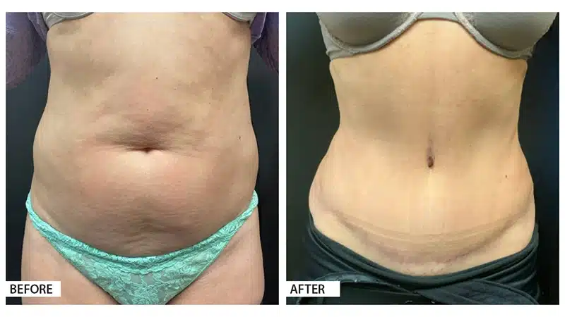 Tummy Tuck