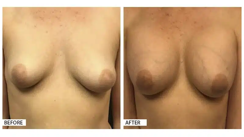 Breast Augmentation