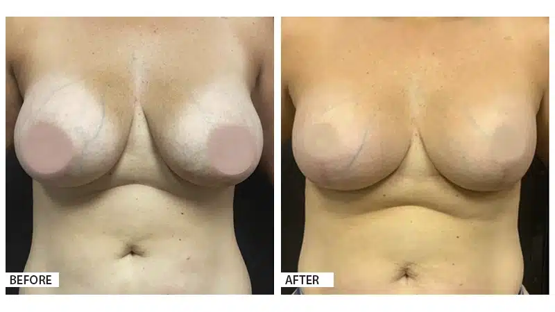 Breast Implant Exchange