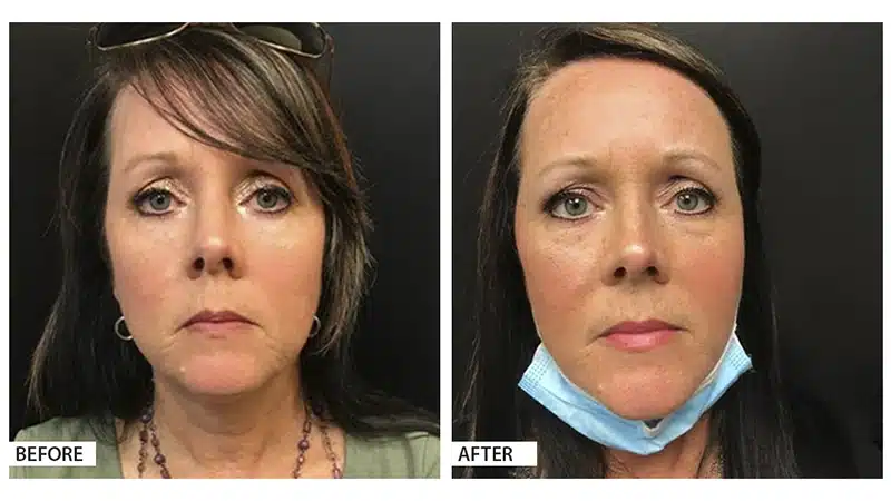 Neck & Face Lift