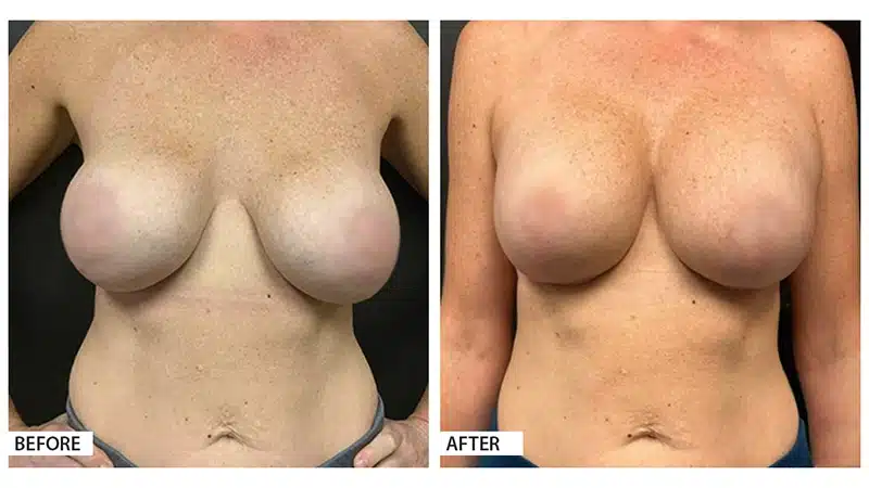 Breast Implant Exchange