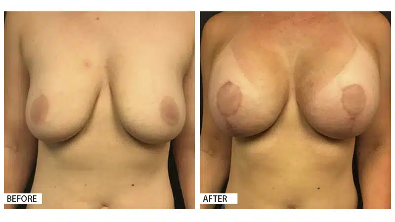 Breast Augmentation