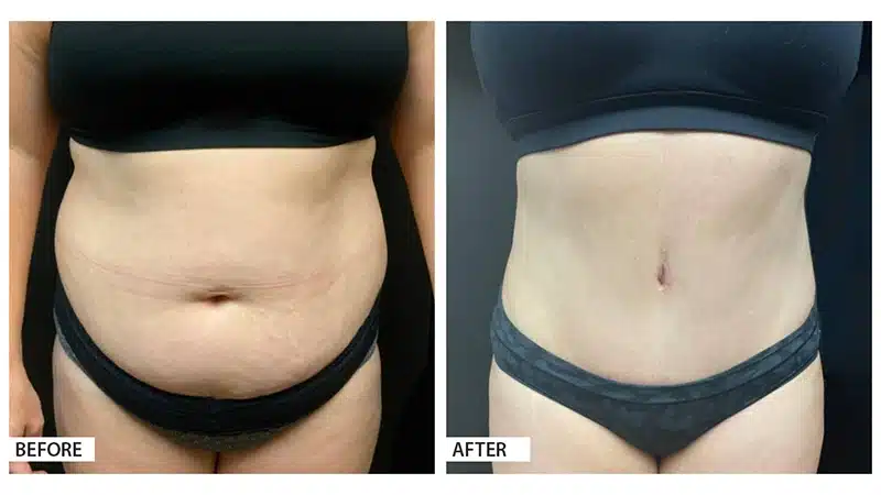 Tummy Tuck