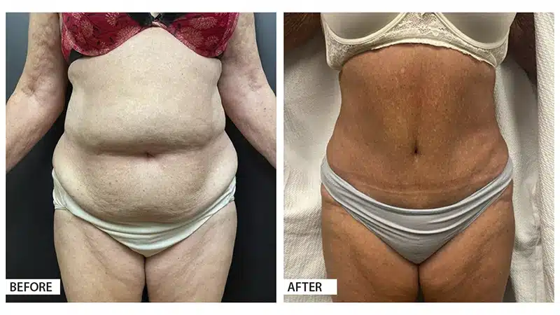 Tummy Tuck