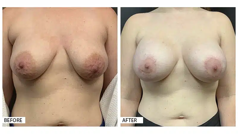 Breast Augmentation