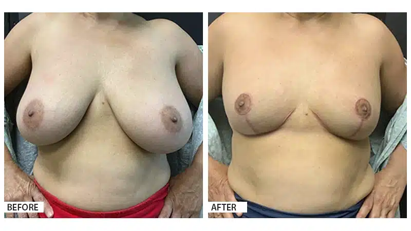 Breast Reduction