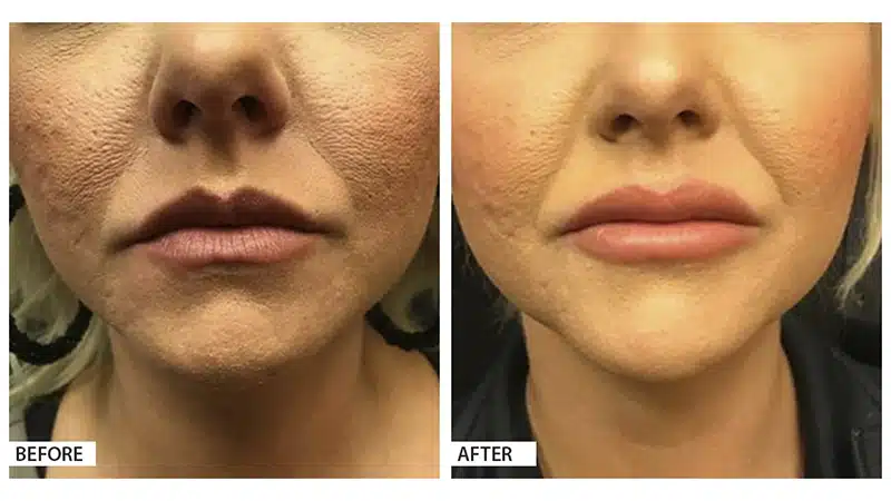 Lip Augmentation