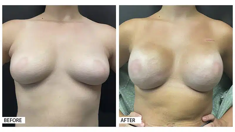 Breast Reconstruction