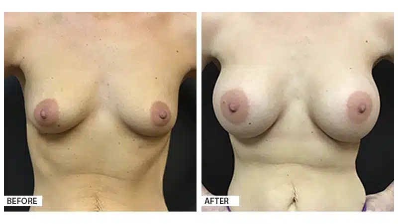 Breast Augmentation