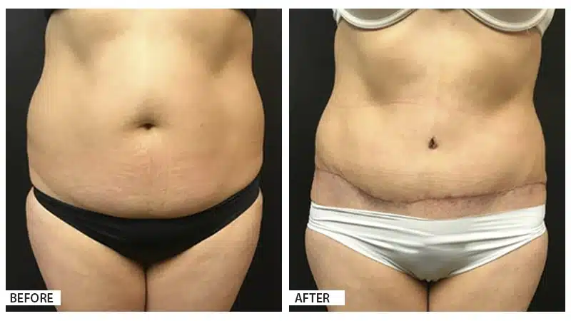 Tummy Tuck