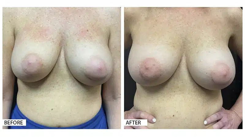 Breast Implant Exchange