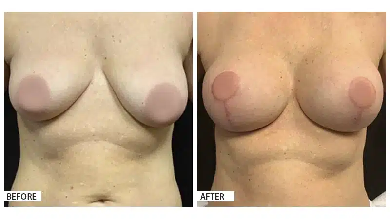 Breast Augmentation