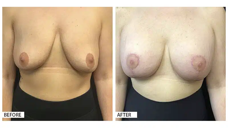 Breast Augmentation