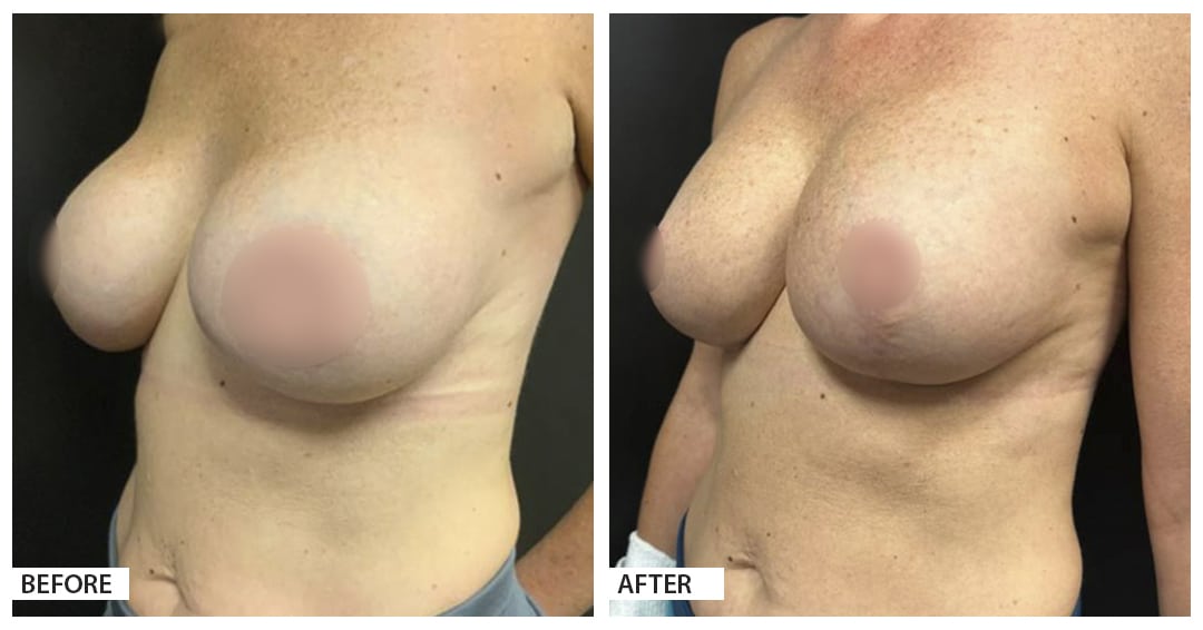 Hattiesburg Clinic Plastic Surgery, Adam N. Franklin, MD, Mastopexy Before and After Photo