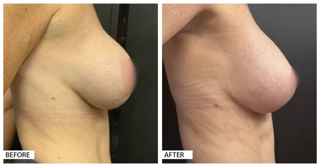 Hattiesburg Clinic Plastic Surgery, Adam N. Franklin, MD, Mastopexy Before and After Photo