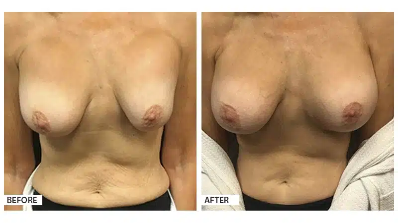 Breast Revision