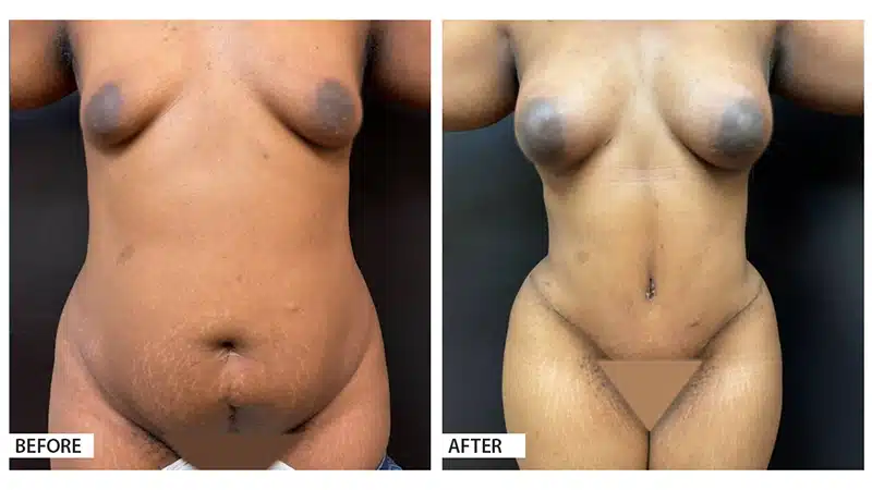 Tummy Tuck