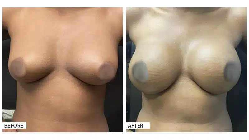 Breast Reconstruction