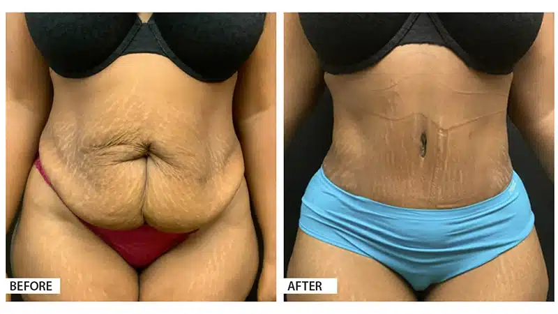 Tummy Tuck