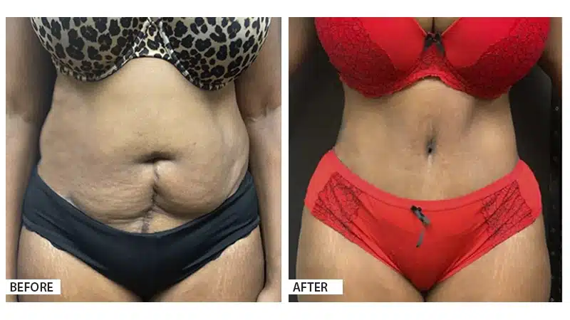 Tummy Tuck