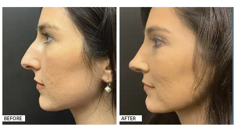 Rhinoplasty