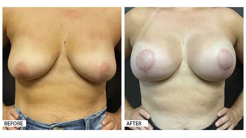 Breast Augmentation