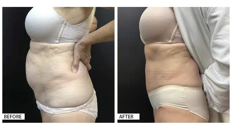 Hattiesburg Clinic Plastic Surgery, Adam N. Franklin, MD. Tummy Tuck with muscle repair and liposuction.