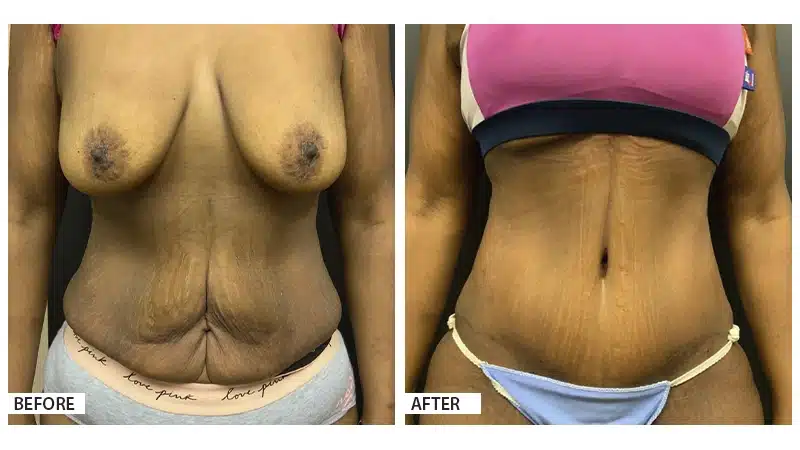 Tummy Tuck