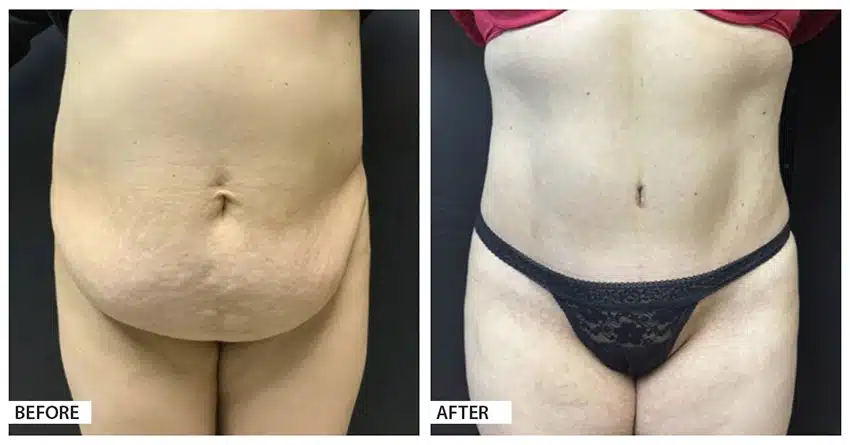 Hattiesburg Clinic Plastic Surgery, Adam N. Franklin, MD, tummy tuck before and after