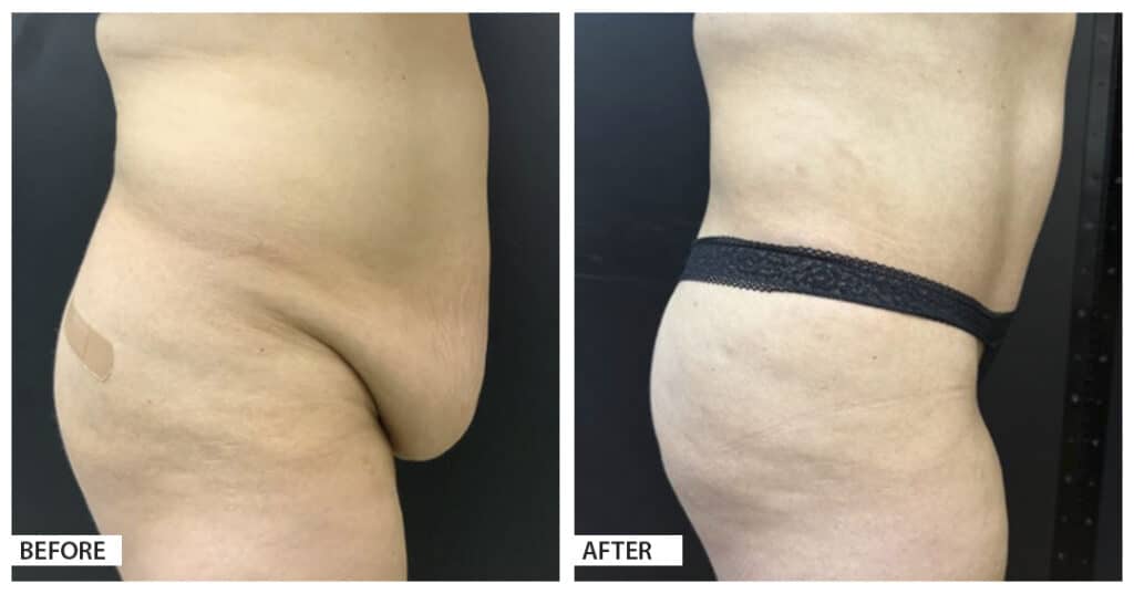 Hattiesburg Clinic Plastic Surgery, Adam N. Franklin, MD, Tummy Tuck Before and After Photo