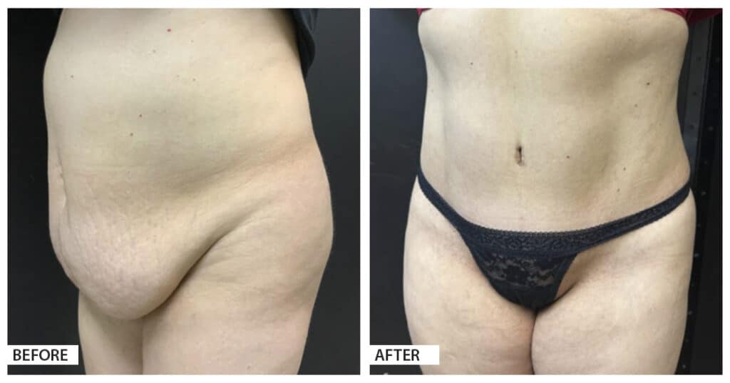 Hattiesburg Clinic Plastic Surgery, Adam N. Franklin, MD, Tummy Tuck Before and After Photo