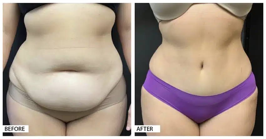 Hattiesburg Clinic Plastic Surgery, Adam N. Franklin, MD, Tummy Tuck Before and After Photo