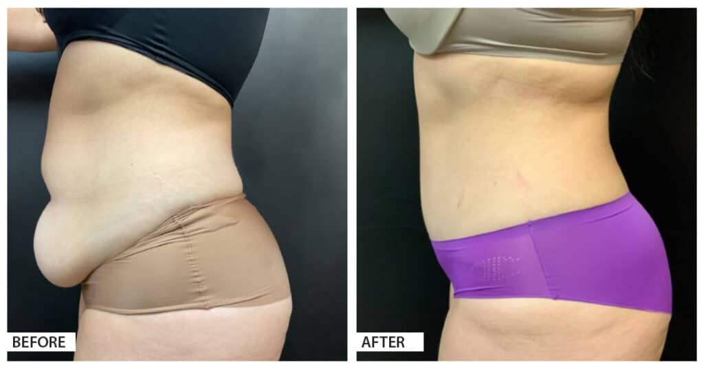 Hattiesburg Clinic Plastic Surgery, Adam N. Franklin, MD, Tummy Tuck Before and After Photo