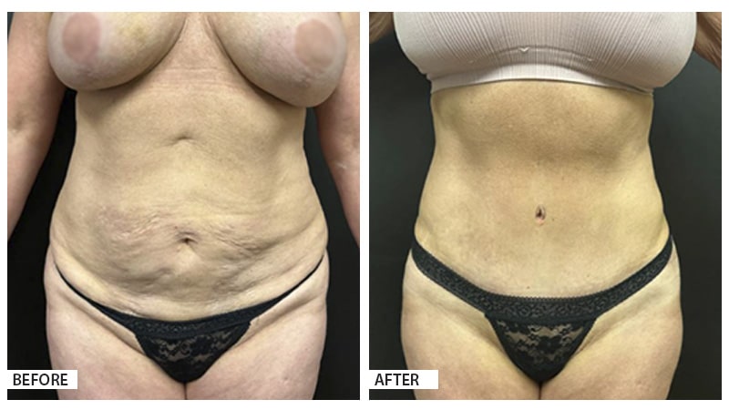 Tummy Tuck