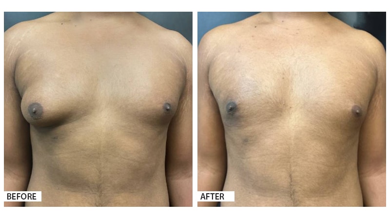 Gynecomastia