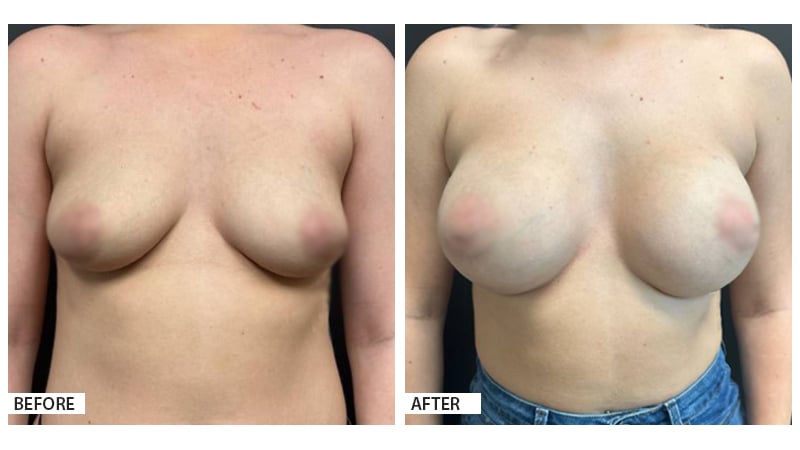 Breast Augmentation