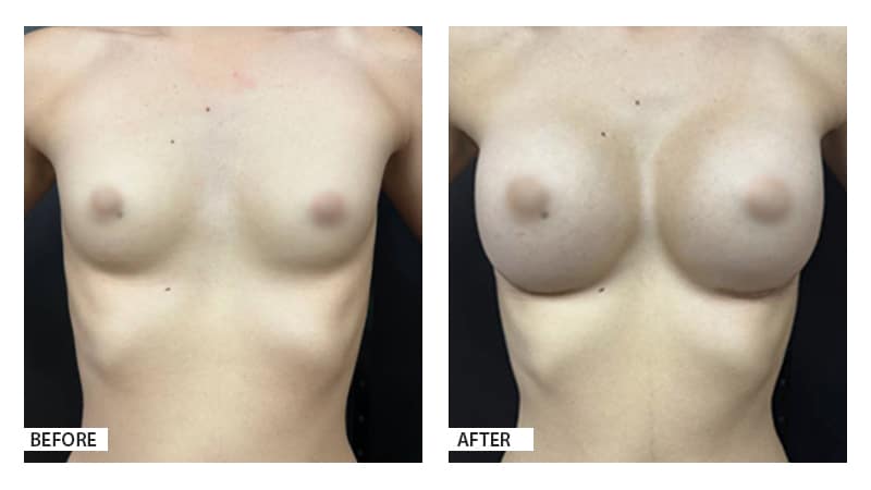 Breast Augmentation