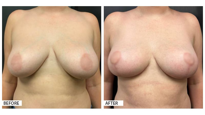 Breast Lift/Reduction