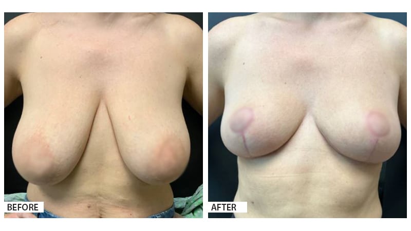 EG Breast Lift/Reduction