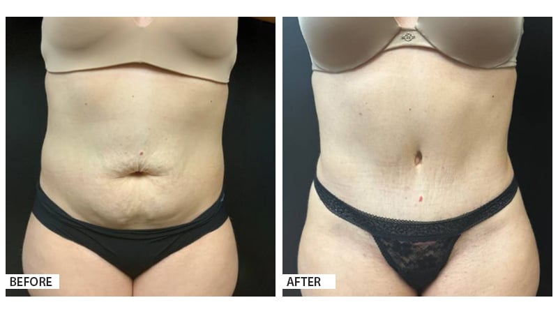 Tummy Tuck