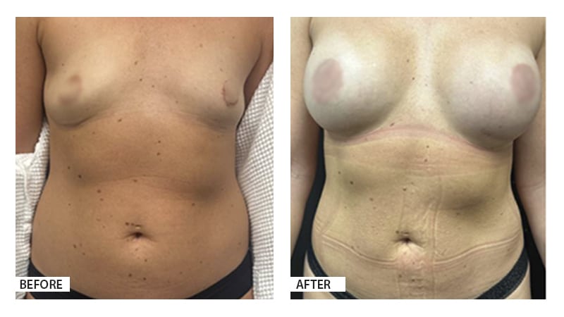 Breast Augmentation 