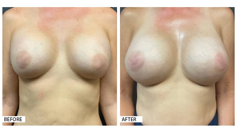 Breast Revision